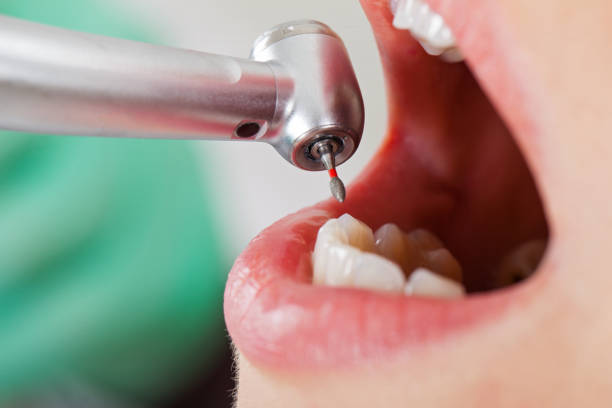 Best Emergency Dental Extractions in Port Norris, NJ